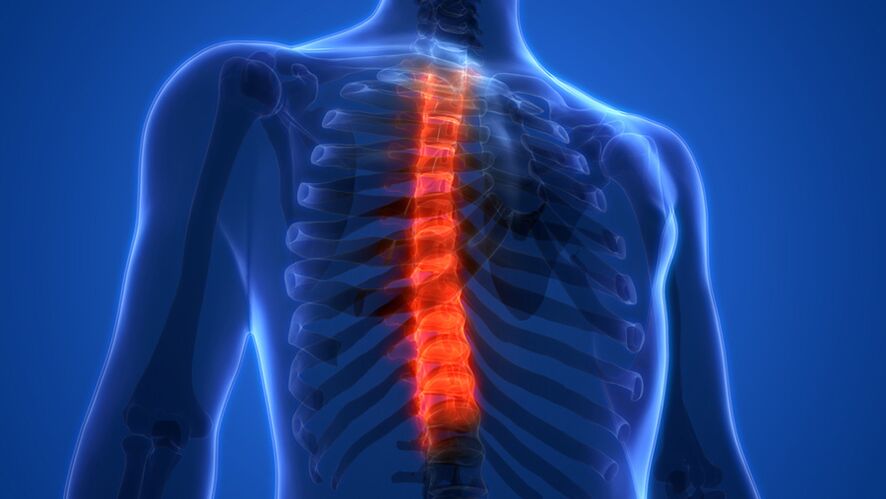 Osteochondrosis sa thoracic spine, nga gihulagway pinaagi sa pagkaguba sa mga intervertebral disc