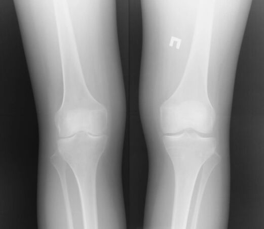 Ang radiograph sa tuhod nga hiniusa