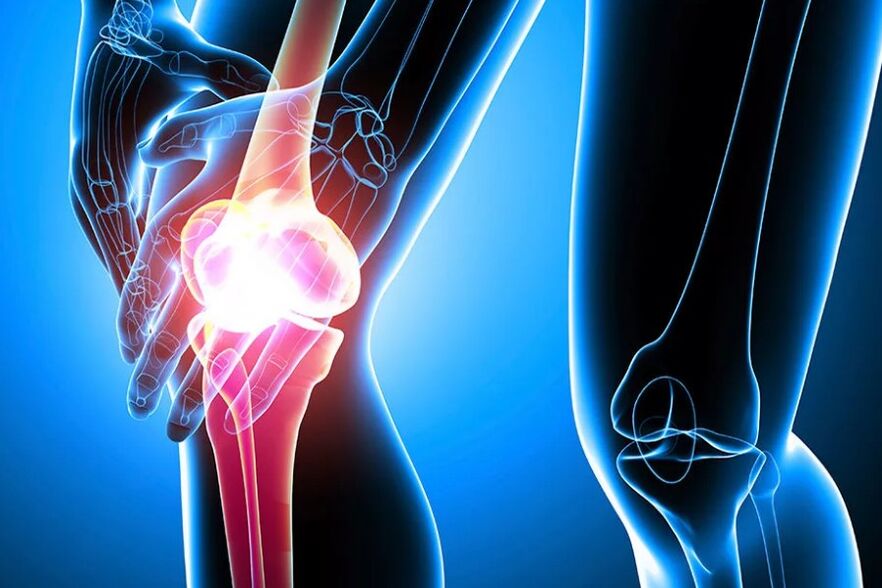 Arthrosis sa tuhod