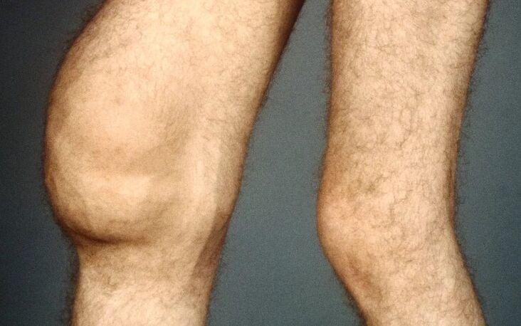 Post -traumumatic arthrosis sa tuhod nga hiniusa