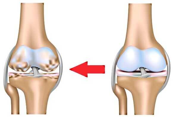 Himsog nga Joint ug Arthrosis