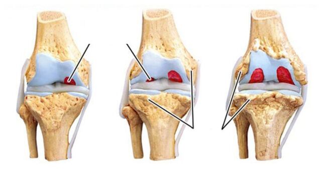 Mga komplikasyon sa arthrosis sa mga lutahan