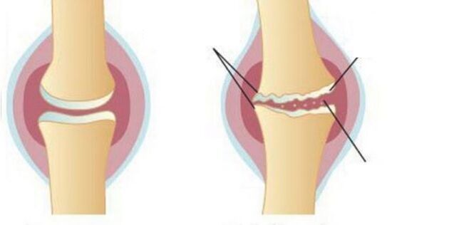 Paghugas sa cartilage