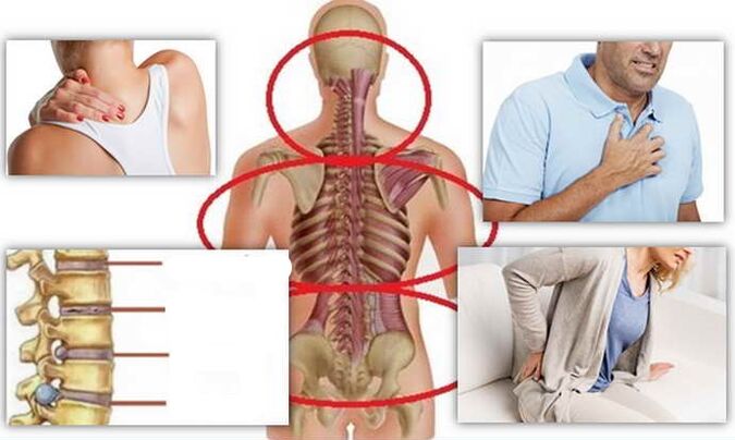 Mga lugar sa sakit alang sa osteochondrosis