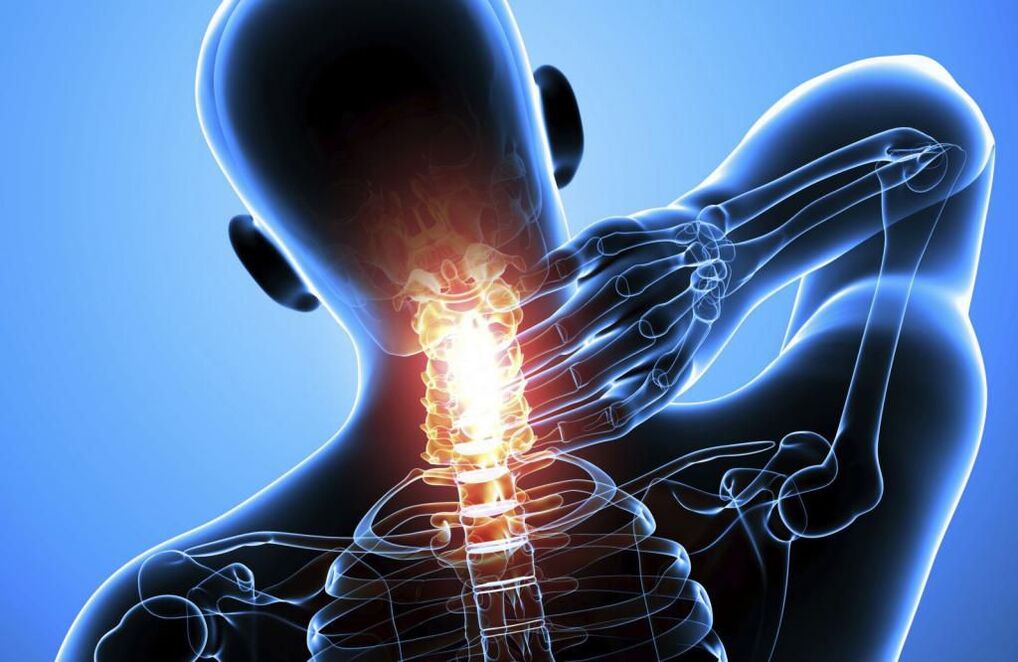 Osteochondrosis sa cervical spine