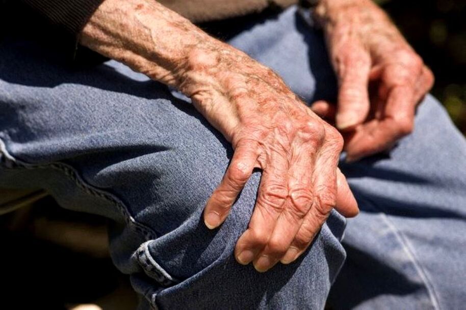 Ang Arthrosis usa ka sakit nga may kalabutan sa edad nga mahitabo sa mga tigulang