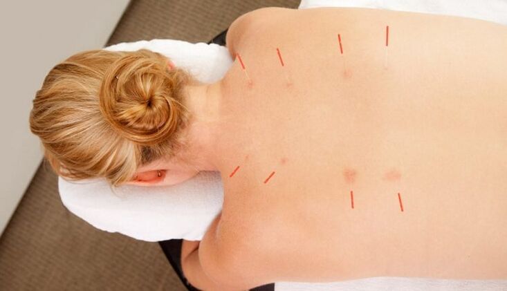 Acupuncture alang sa thoracic osteochondrosis, nga adunay daghang mga bentaha